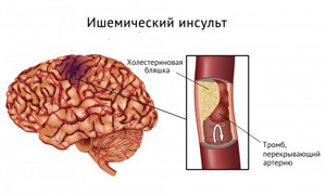 ишемический инсульт ишемический инсульт