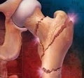 последствия дефицита кальция в организме